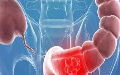 У плодовых мушек выявлены признаки рака кишечника человека