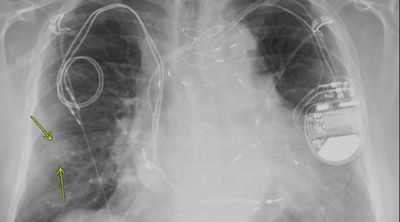 Безопасное выполнение МРТ у пациентов с кардиостимуляторами и ИКД